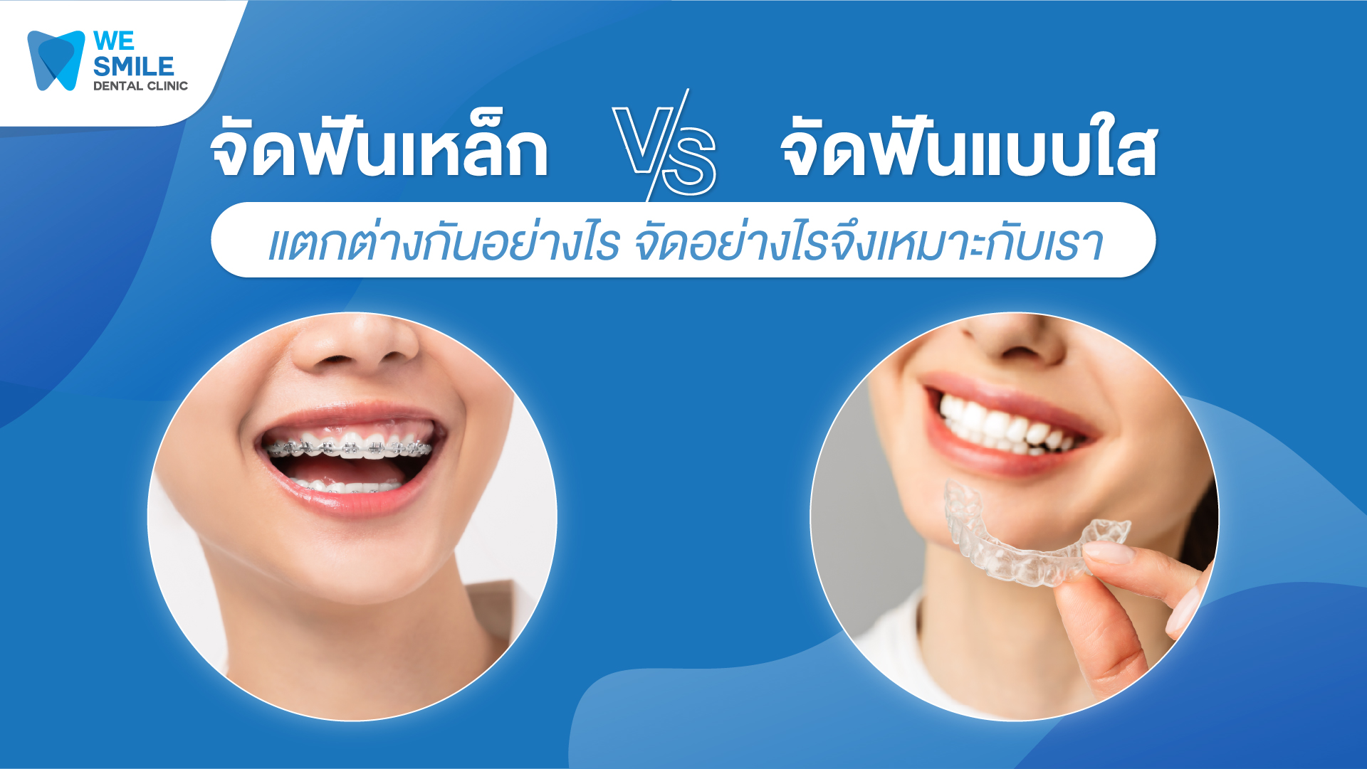 จัดฟันเหล็ก vs จัดฟันแบบไหน แตกต่างกันอย่างไร จัดอย่างไรจึงเหมาะกับเรา