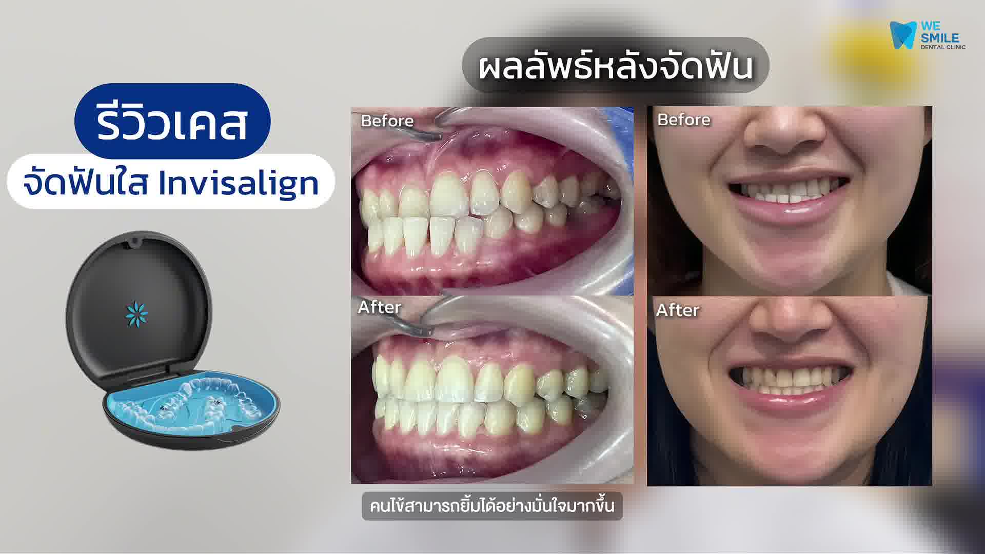 ภาพเปรียบเทียบก่อนและหลังการรักษาฟันสบคร่อมด้วยการจัดฟันใส Invisalign