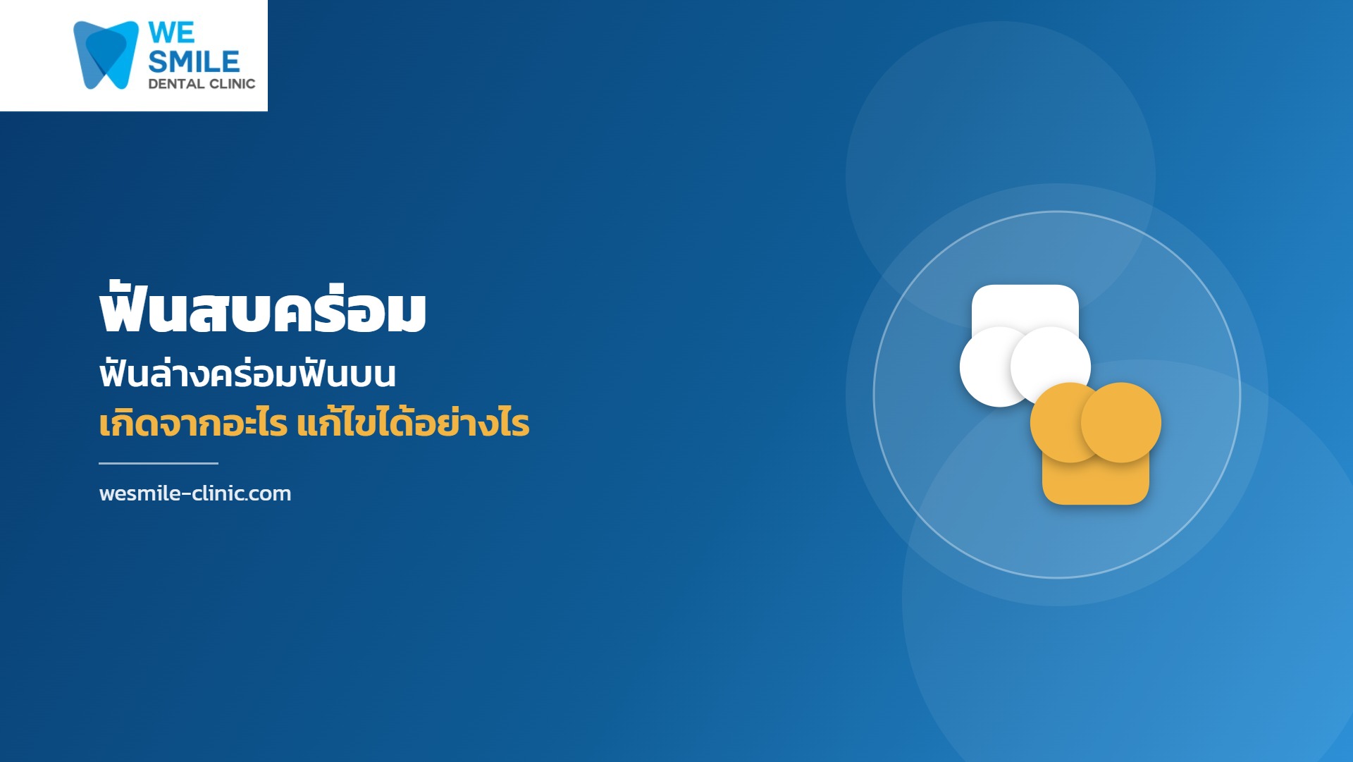 ฟันสบคร่อม ฟันล่างคร่อมฟันบน เกิดจากอะไร แก้ไขได้อย่างไร - We Smile Dental Clinic