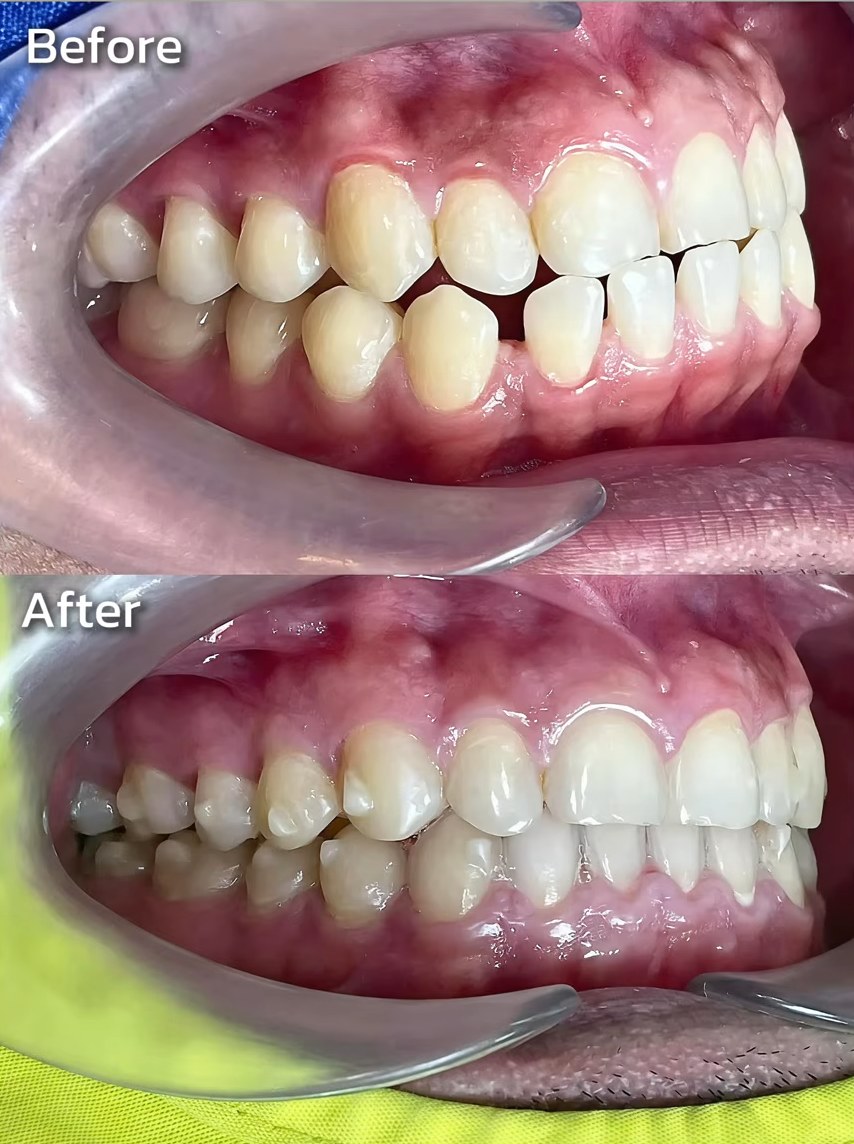 ภาพเปรียบเทียบก่อนและหลังจัดฟันใส Essentials by Invisalign ปิดช่องห่างฟันหน้าล่าง ระยะเวลาประมาณ 10 เดือน