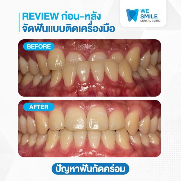 ก่อนและหลังจัดฟันแบบติดเครื่องมือ ปัญหาฟันกัดคร่อม