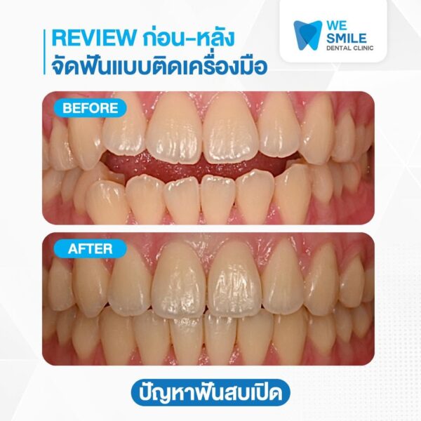 ก่อนและหลังจัดฟันแบบติดเครื่องมือ ปัญหาฟันสบเปิด