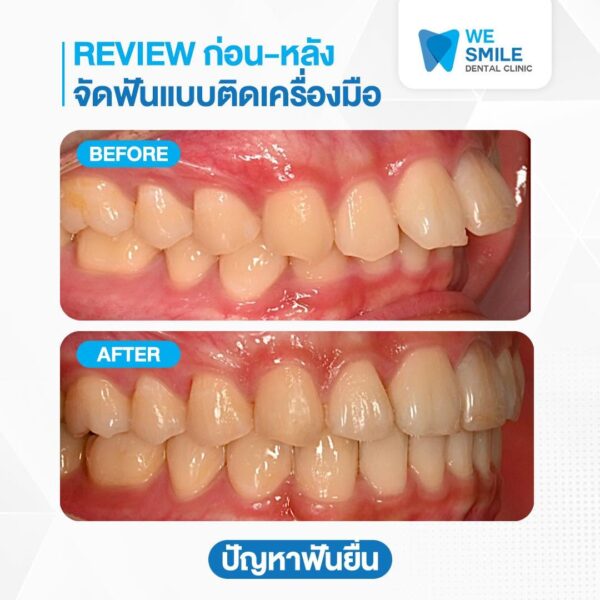 ก่อนและหลังจัดฟันแบบติดเครื่องมือ ปัญหาฟันยื่น