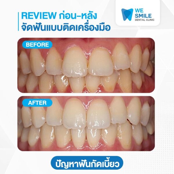 ก่อนและหลังจัดฟันแบบติดเครื่องมือ ปัญหาฟันกัดเบี้ยว