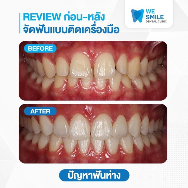 ก่อนและหลังจัดฟันแบบติดเครื่องมือ ปัญหาฟันห่าง