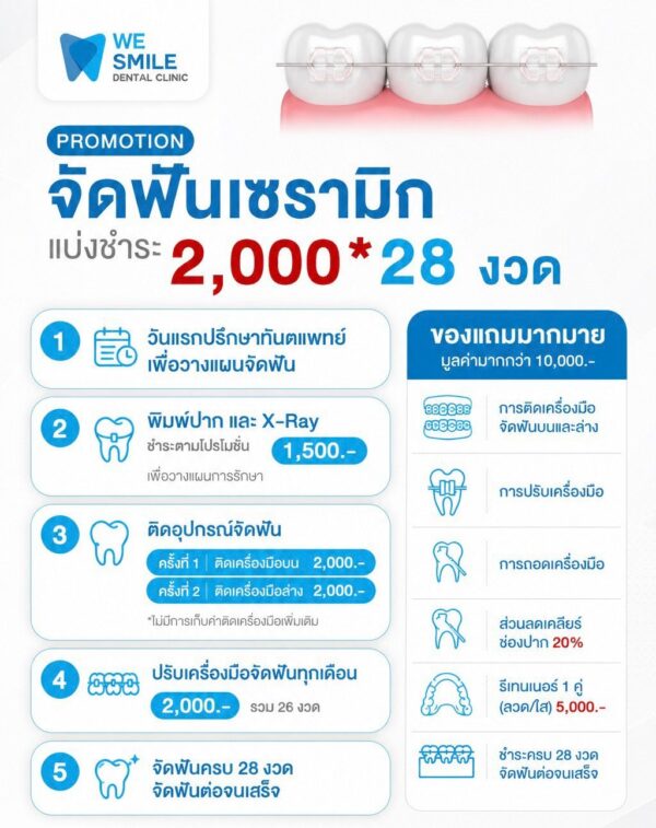 โปรโมชั่นจัดฟันเซรามิก แบ่งชำระ 2,000 บาท 28 งวด