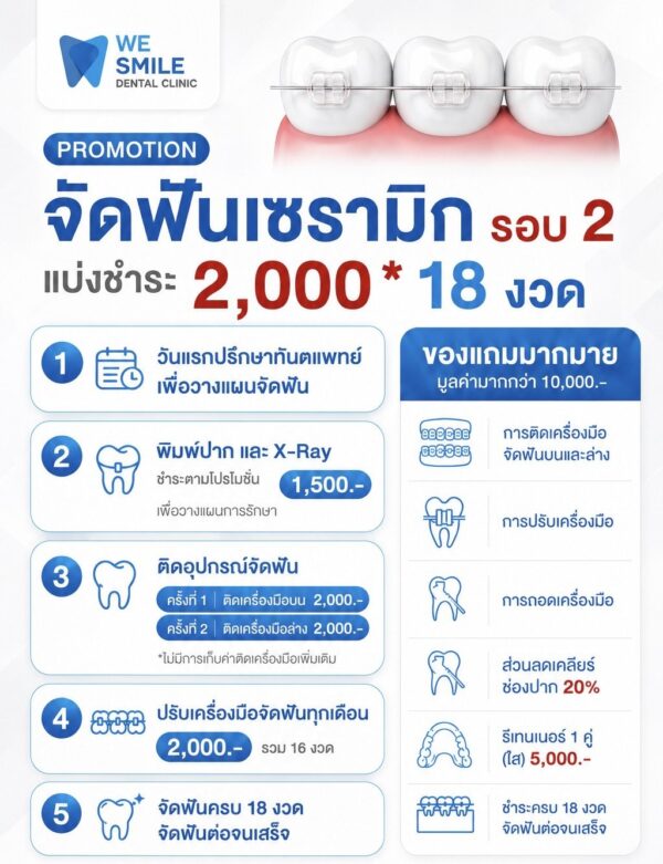 โปรโมชั่นจัดฟันเซรามิกอีกรอบ แบ่งชำระ 2,000 บาท 18 งวด
