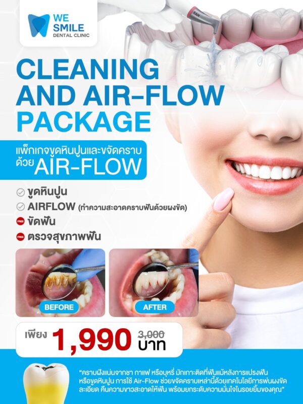 แพ็กเกจขูดหินปูน + Air-Flow