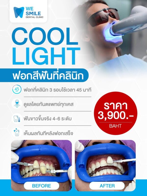 ฟอกสีฟัน Cool Light (Pola Whitening) ที่คลินิก ราคา 3,900 บาท