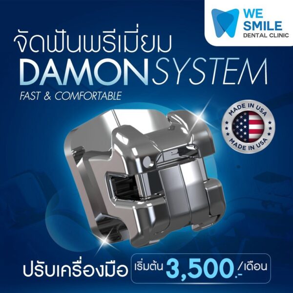 จัดฟัน Damon System ปรับเครื่องมือเริ่มต้นเดือนละ 3,500 บาท