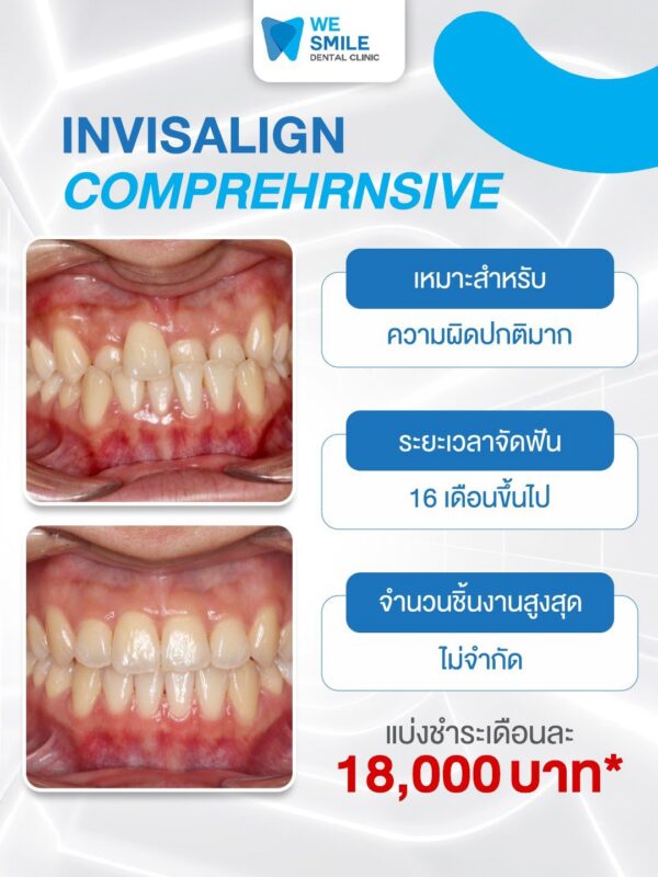 แพ็กเกจ Invisalign Comprehensive ราคา 180,000 บาท