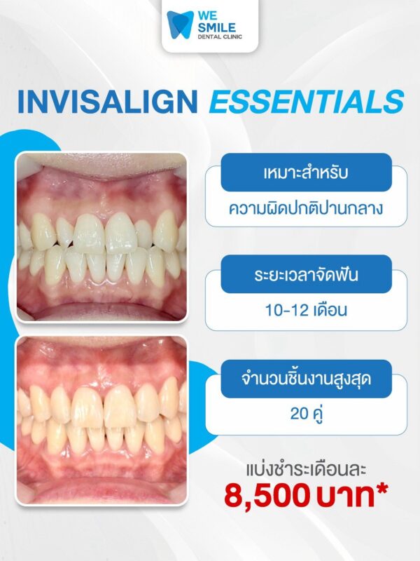 แพ็กเกจ Invisalign Essentials ราคา 85,000 บาท
