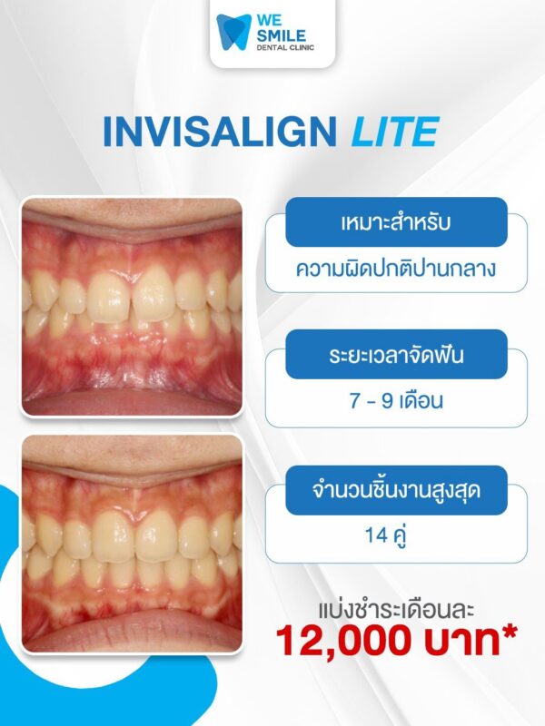 แพ็กเกจ Invisalign Lite ราคา 120,000 บาท