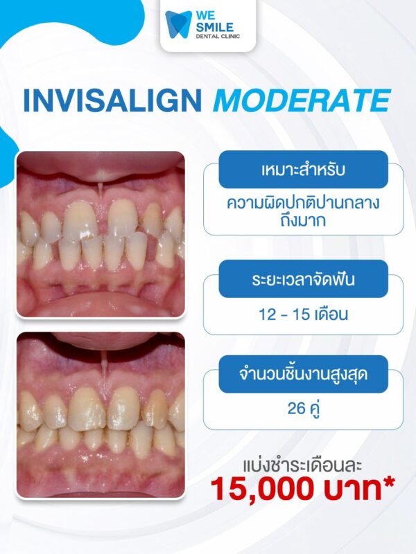 แพ็กเกจ Invisalign Moderate ราคา 150,000 บาท