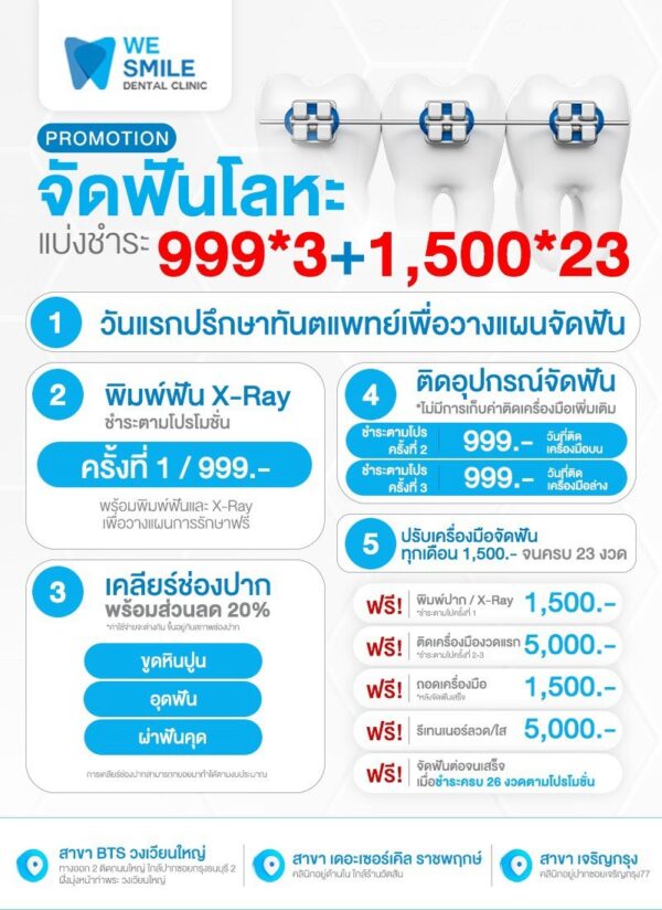 โปรโมชั่นจัดฟันโลหะ แบ่งชำระ 999 บาท 3 งวด และ 1,500 บาท 23 งวด