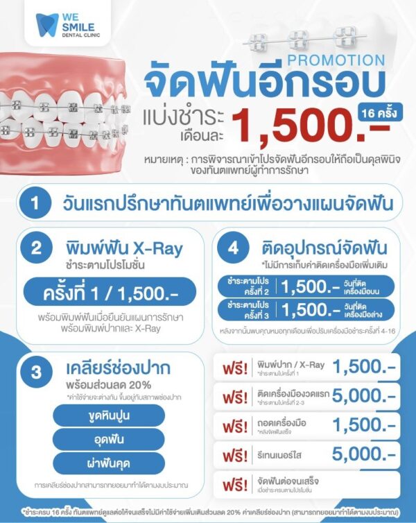 โปรโมชั่นจัดฟันโลหะอีกรอบ แบ่งชำระเดือนละ 1,500 บาท 16 ครั้ง
