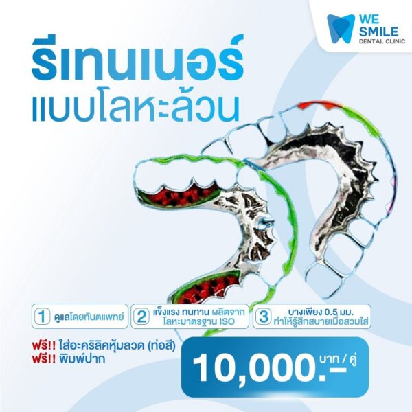 รีเทนเนอร์แบบโลหะล้วน ราคา 10,000 บาทต่อคู่