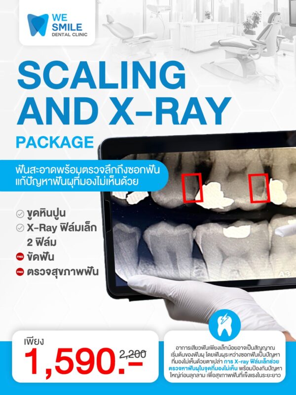 แพ็กเกจขูดหินปูน + X-Ray