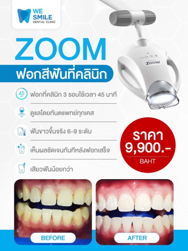 ฟอกสีฟัน Philips Zoom ที่คลินิก ราคา 9,900 บาท
