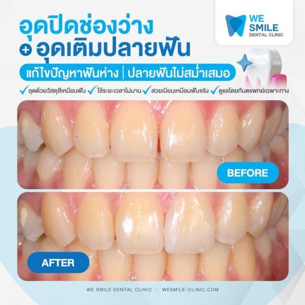 ผลอุดปิดช่องว่างและอุดเติมปลายฟันก่อนและหลัง
