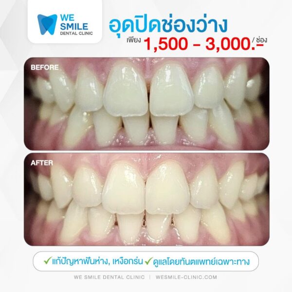ผลอุดปิดช่องฟันห่างก่อนและหลัง