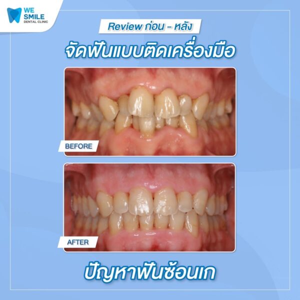 ผลจัดฟันติดเครื่องมือก่อนและหลัง ปัญหาฟันซ้อนเก