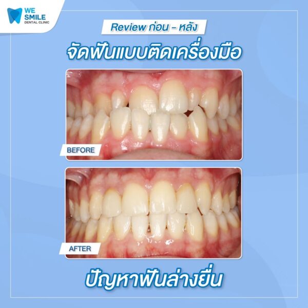 ผลจัดฟันติดเครื่องมือก่อนและหลัง ปัญหาฟันล่างยื่น