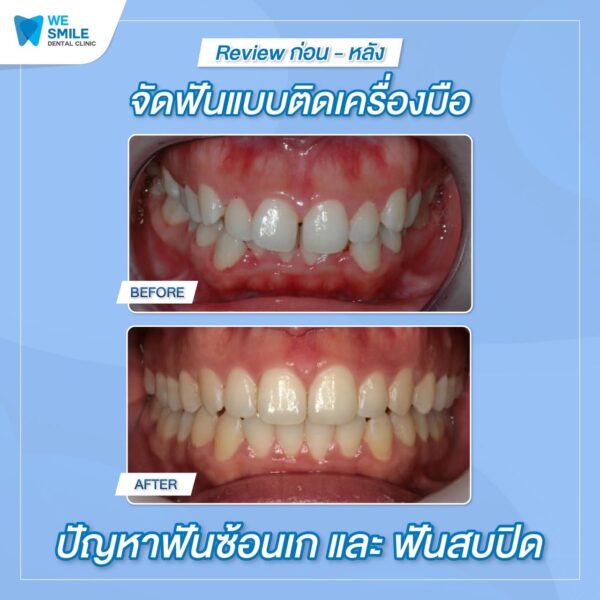 ผลจัดฟันติดเครื่องมือก่อนและหลัง ปัญหาฟันซ้อนเกและฟันสบปิด