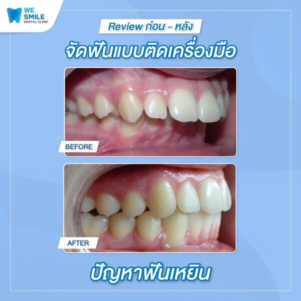 ผลจัดฟันติดเครื่องมือก่อนและหลัง ปัญหาฟันเหยิน