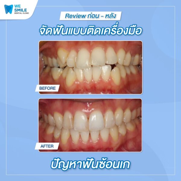 ผลจัดฟันติดเครื่องมือก่อนและหลัง ปัญหาฟันซ้อนเก