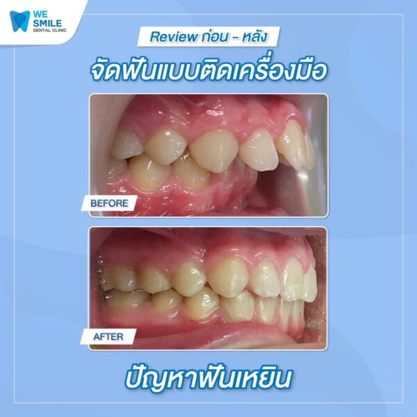 ผลจัดฟันติดเครื่องมือก่อนและหลัง ปัญหาฟันเหยิน