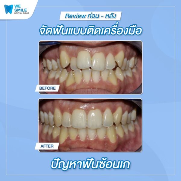 ผลจัดฟันติดเครื่องมือก่อนและหลัง ปัญหาฟันซ้อนเก