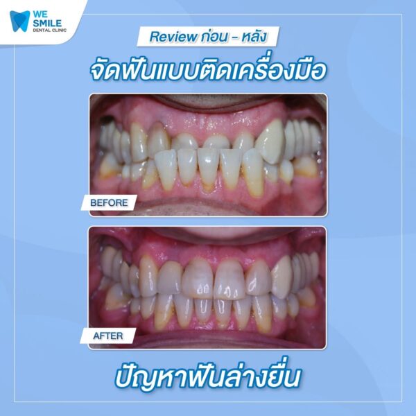 ผลจัดฟันติดเครื่องมือก่อนและหลัง ปัญหาฟันล่างยื่น
