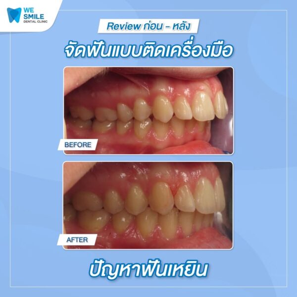 ผลจัดฟันติดเครื่องมือก่อนและหลัง ปัญหาฟันเหยิน