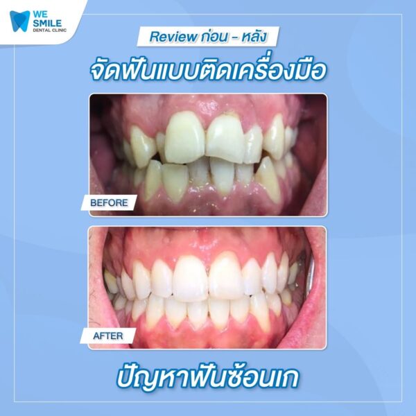 ผลจัดฟันติดเครื่องมือก่อนและหลัง ปัญหาฟันซ้อนเก