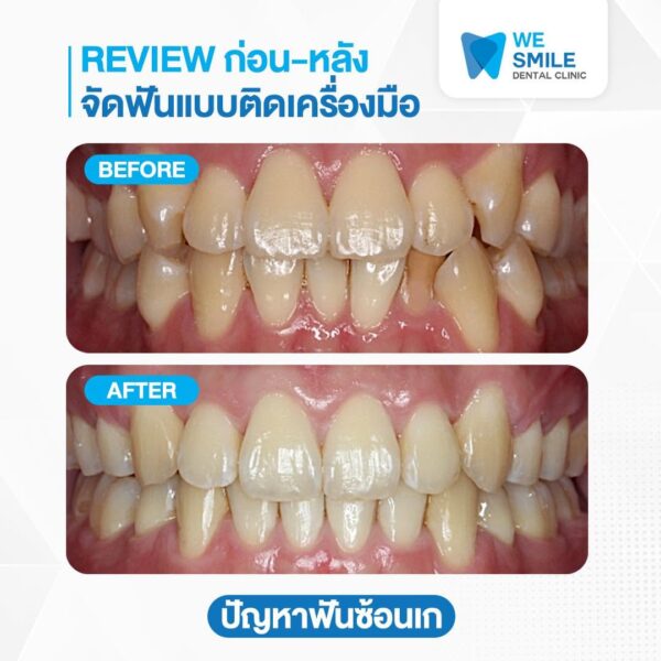 ผลจัดฟันก่อนและหลัง ปัญหาฟันซ้อนเก