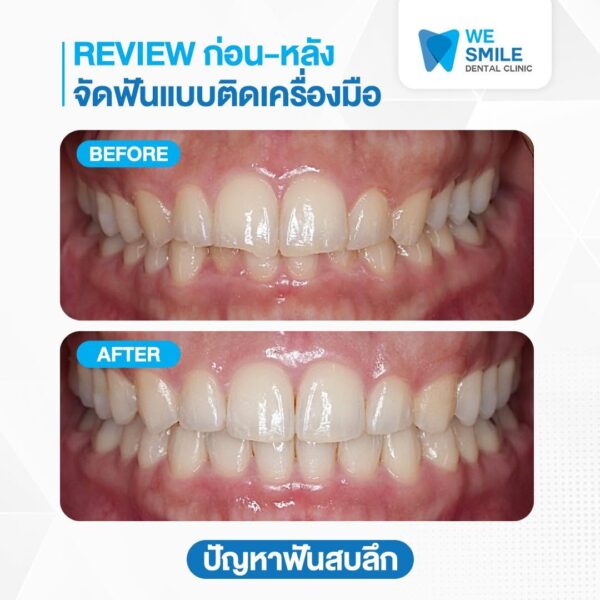 ผลจัดฟันก่อนและหลัง ปัญหาฟันสบลึก
