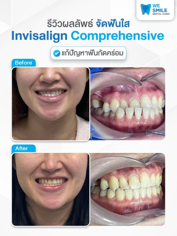 ผลจัดฟันใส Invisalign Comprehensive ก่อนและหลัง ภาพใบหน้าและฟัน