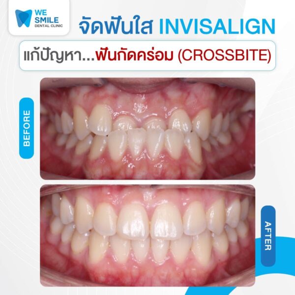 ผลจัดฟันใส Invisalign ก่อนและหลัง ปัญหาฟันกัดคร่อม