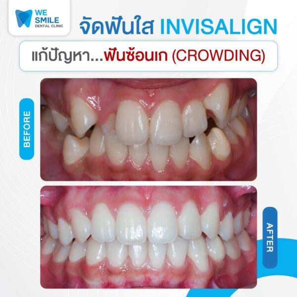 ผลจัดฟันใส Invisalign ก่อนและหลัง ปัญหาฟันซ้อนเก