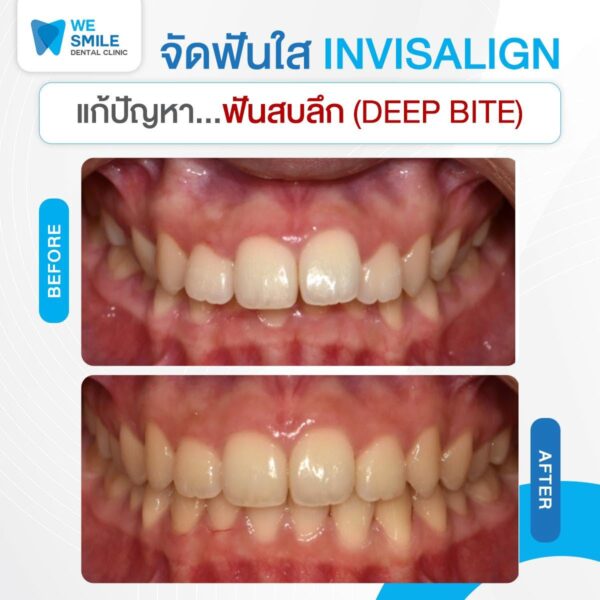 ผลจัดฟันใส Invisalign ก่อนและหลัง ปัญหาฟันสบลึก