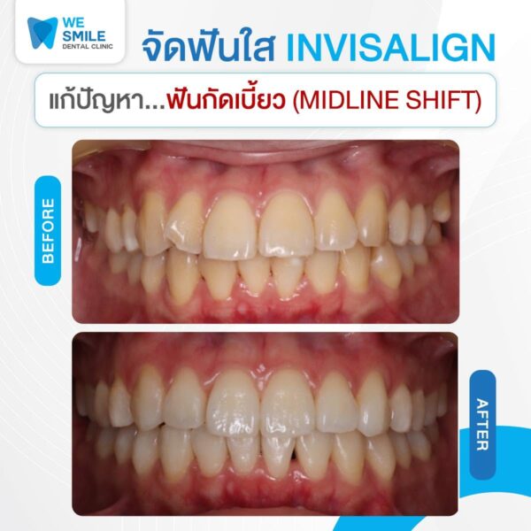 ผลจัดฟันใส Invisalign ก่อนและหลัง ปัญหาแนวกึ่งกลางฟันไม่ตรงกัน