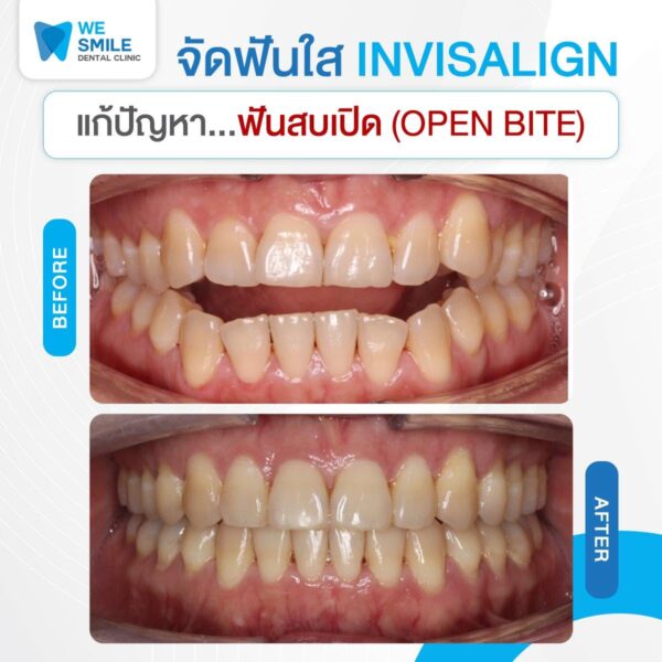 ผลจัดฟันใส Invisalign ก่อนและหลัง ปัญหาฟันสบเปิด
