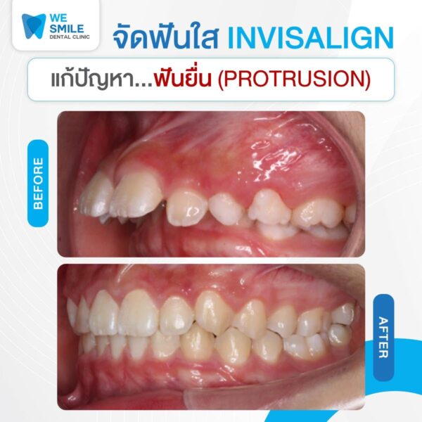 ผลจัดฟันใส Invisalign ก่อนและหลัง ปัญหาฟันยื่น