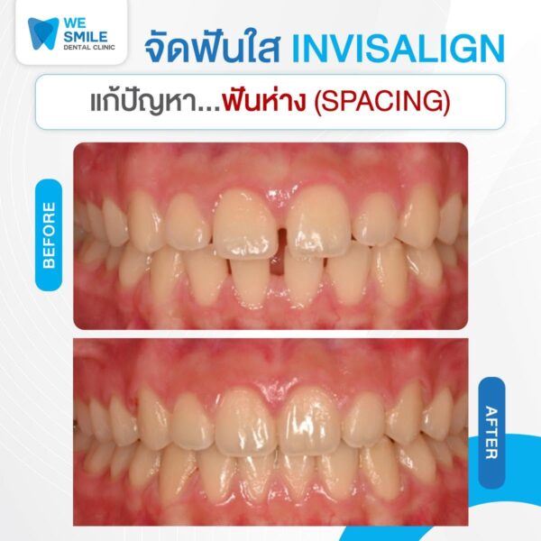 ผลจัดฟันใส Invisalign ก่อนและหลัง ปัญหาฟันห่าง