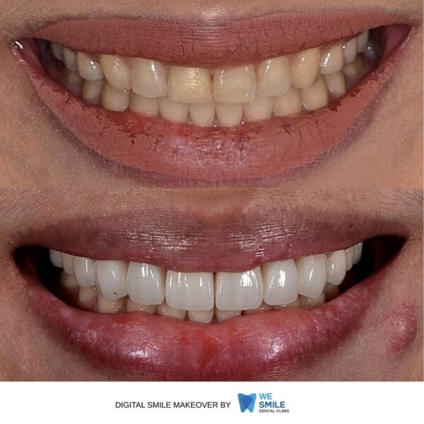 รอยยิ้มก่อนและหลังทำ Digital Smile Makeover เคสที่ 1