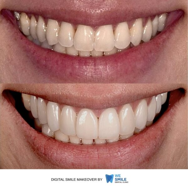 รอยยิ้มก่อนและหลังทำ Digital Smile Makeover เคสที่ 2