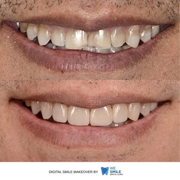 รอยยิ้มก่อนและหลังทำ Digital Smile Makeover เคสที่ 3