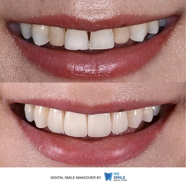 รอยยิ้มก่อนและหลังทำ Digital Smile Makeover เคสที่ 4