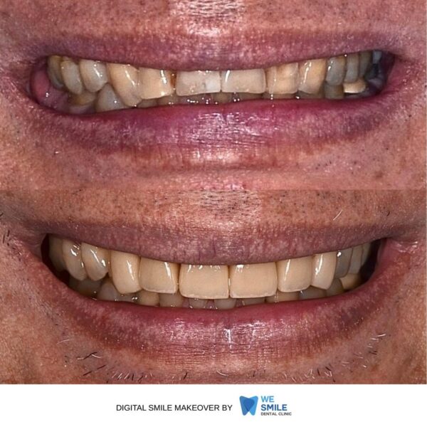 รอยยิ้มก่อนและหลังทำ Digital Smile Makeover เคสที่ 5